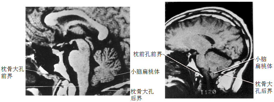枕骨大孔疝即小脑扁桃体疝(图5-附-1),延髓的生命中枢受挤压导致呼吸