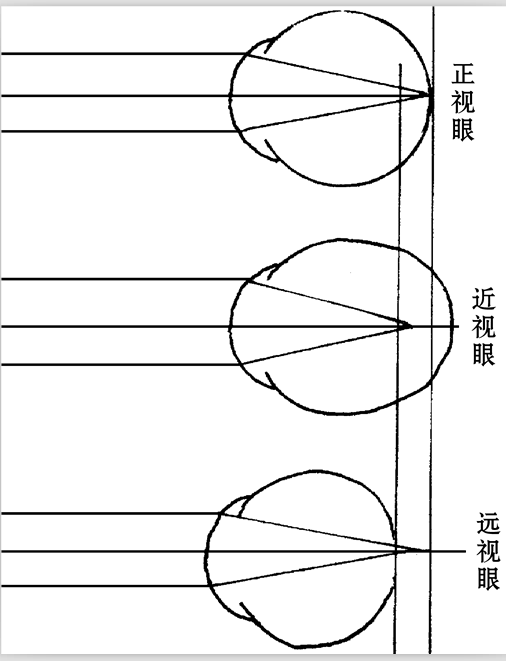 近视指因眼球前后径比正常长或屈光物质(主要是晶状体)屈光过度,以致