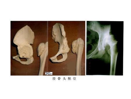 11股骨头脱位.jpg