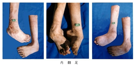 9内翻足.jpg