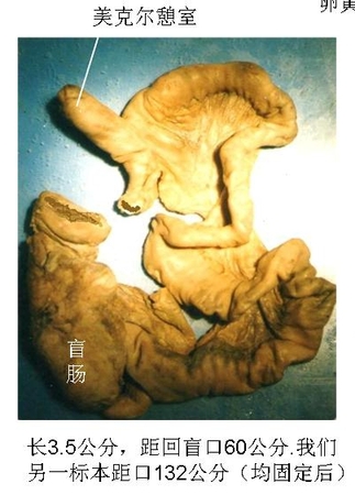 20美克尔憩室.jpg