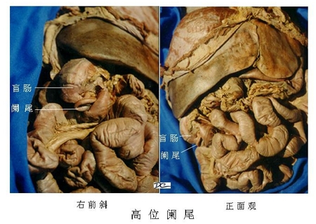 17高位阑尾.jpg