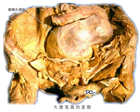 19大便充盈的直肠.jpg