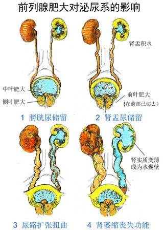 6前列腺大伤肾.jpg