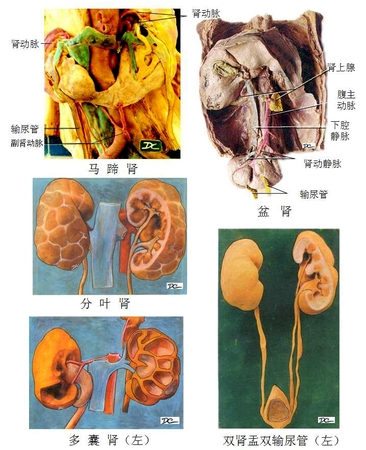 22肾异常.jpg