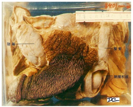 26隐睾、鞘膜积液.jpg