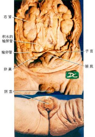 32女性假两性畸形.jpg