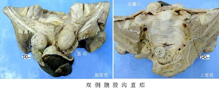 41双侧直疝.jpg