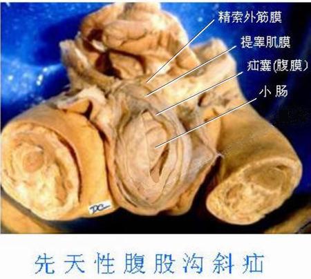 40先天腹股沟斜疝.jpg