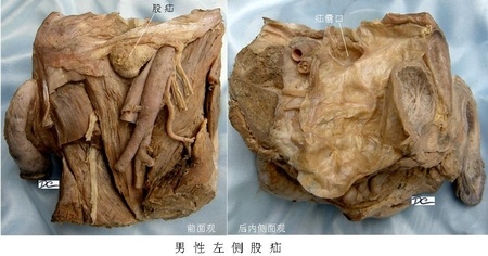 43男左侧股疝.jpg
