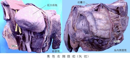 42男右侧巨大股疝.jpg