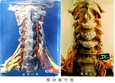 53椎动脉行程.jpg