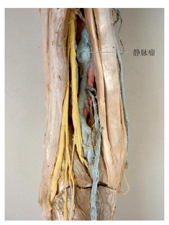 58静脉瘤.jpg