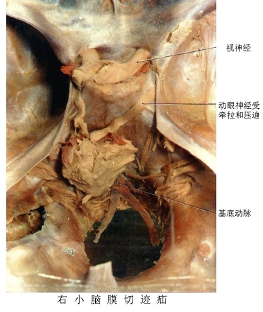 60右小脑膜切迹疝.jpg