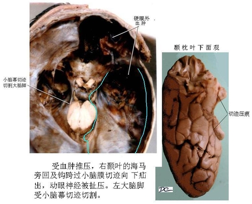 61小脑膜切迹疝