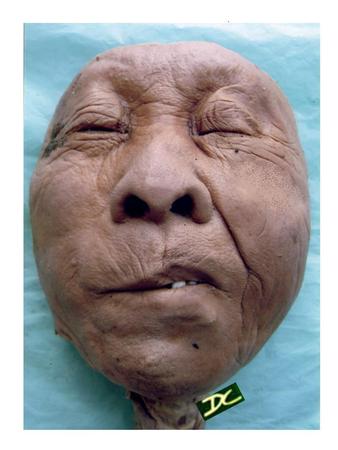 63右鼻唇沟.jpg