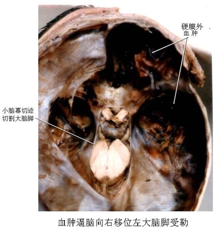 62硬膜外血肿.jpg